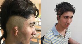 Doctors at Jaypee Hospital successfully reconstructed an ear of an Afghanistani national