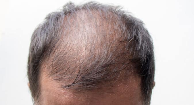 Is minoxidil the best treatment for baldness? 6 things an expert wants you  to know 