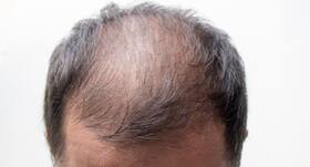 Is minoxidil the best treatment for baldness? 6 things an expert wants you to know Is minoxidil the best treatment for baldness? 6 things an expert wants you to know