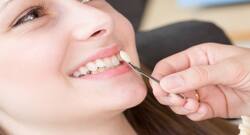 Planning to get dental veneers? Read this first!