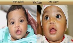 Cleft lip surgery: Fortis Foundation’s ‘Umeed-Smile’ initiative treats 4-year-old in Gurgaon