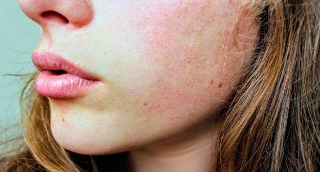 Remedies for skin sunburn relief स्किन केयर टिप्स