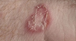 स्किन की बीमारी है स्केबीज (Scabies), जानें इसके बारे में 5 जरूरी बातें