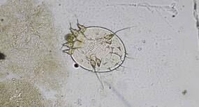 Woman 'eaten alive' by mites in a hospital; 5 facts about scabies that you should know