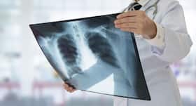 Tuberculosis in kids – everything you need to know