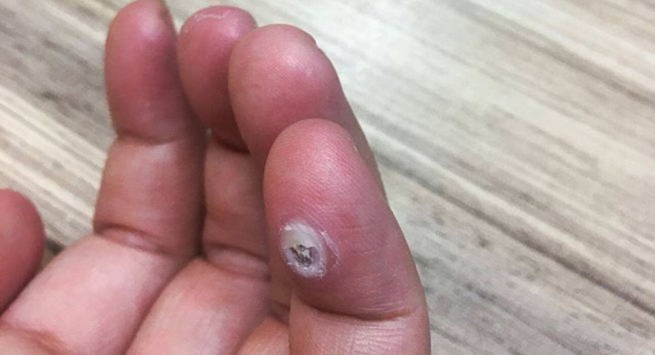 Treatment for warts: Follow these 4 tips