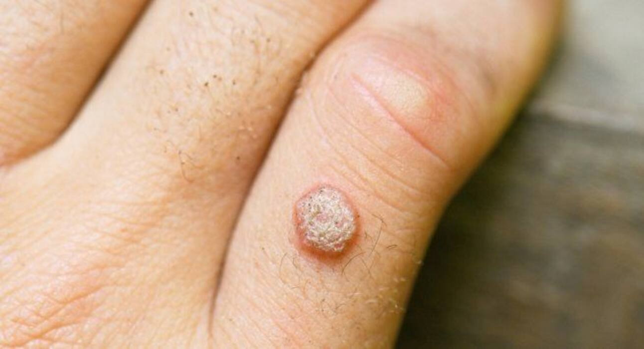 Treatment for warts: Follow these 4 tips