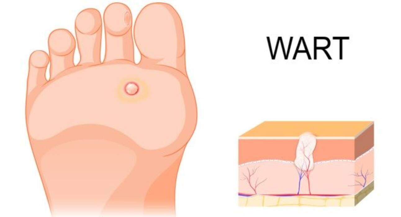 Treatment for warts: Follow these 4 tips