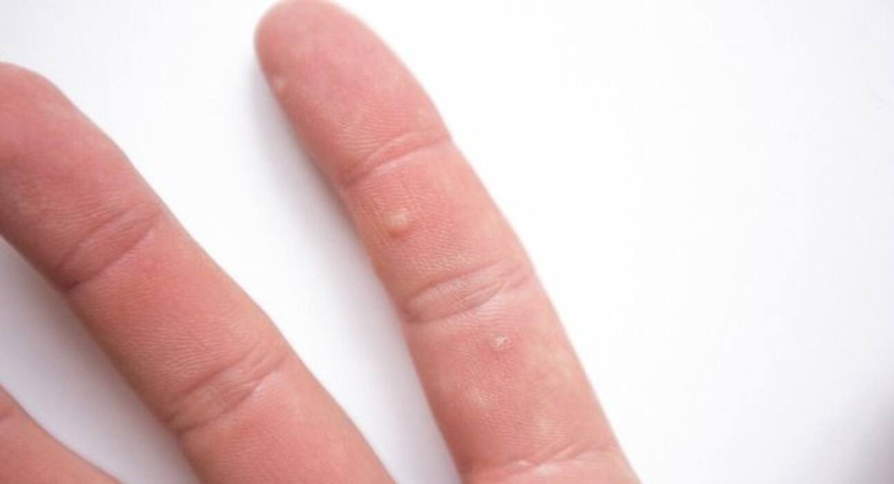 Treatment for warts: Follow these 4 tips