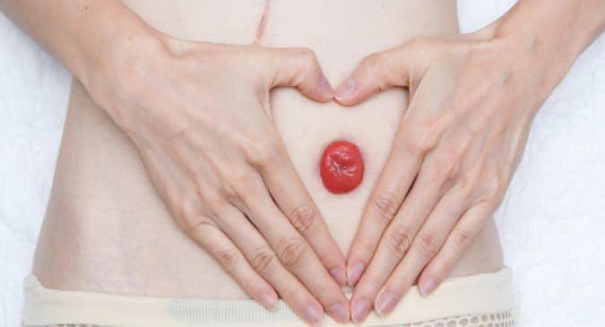 Body image and stoma health and social care essay 03 picture