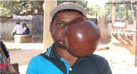 Football-size tumour from tribal boy’s jaw removed