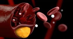 Sickle cell anaemia: Know how to manage its symptoms naturally