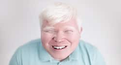 International Albinism Awareness Day 2018: These are the eye conditions albinos suffer from
