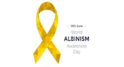 International Albinism Awareness Day 2018: Myths and treatment options