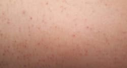 Want to get rid of ingrown hair? Go au naturel