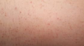 Want to get rid of ingrown hair? Go au naturel
