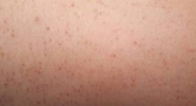 Ingrown hair: 6 reasons you're getting them!