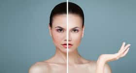A dermatologist explains how to deal with open pores