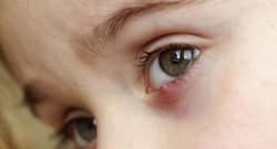 Stye remedies and tips you can try!