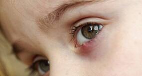 Stye remedies and tips you can try!
