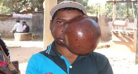 Football-size tumour removed from a 19-year-old tribal boy’s jaw