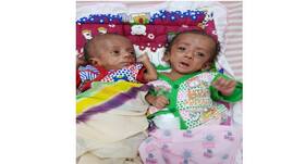 Miracle: Premature babies weighing just 475 gm and 617 gm among the smallest twins to survive in India!