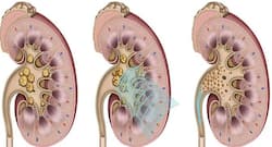 किडनी की बीमारी में जीन थेरपी से हो सकता है सफल इलाज