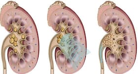 All you need to know about the risk stages for children with chronic kidney disease