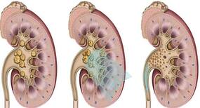 All you need to know about the risk stages for children with chronic kidney disease