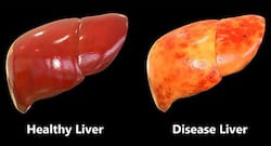 हेल्दी लिवर के लिए 4 बेहतरीन फूड