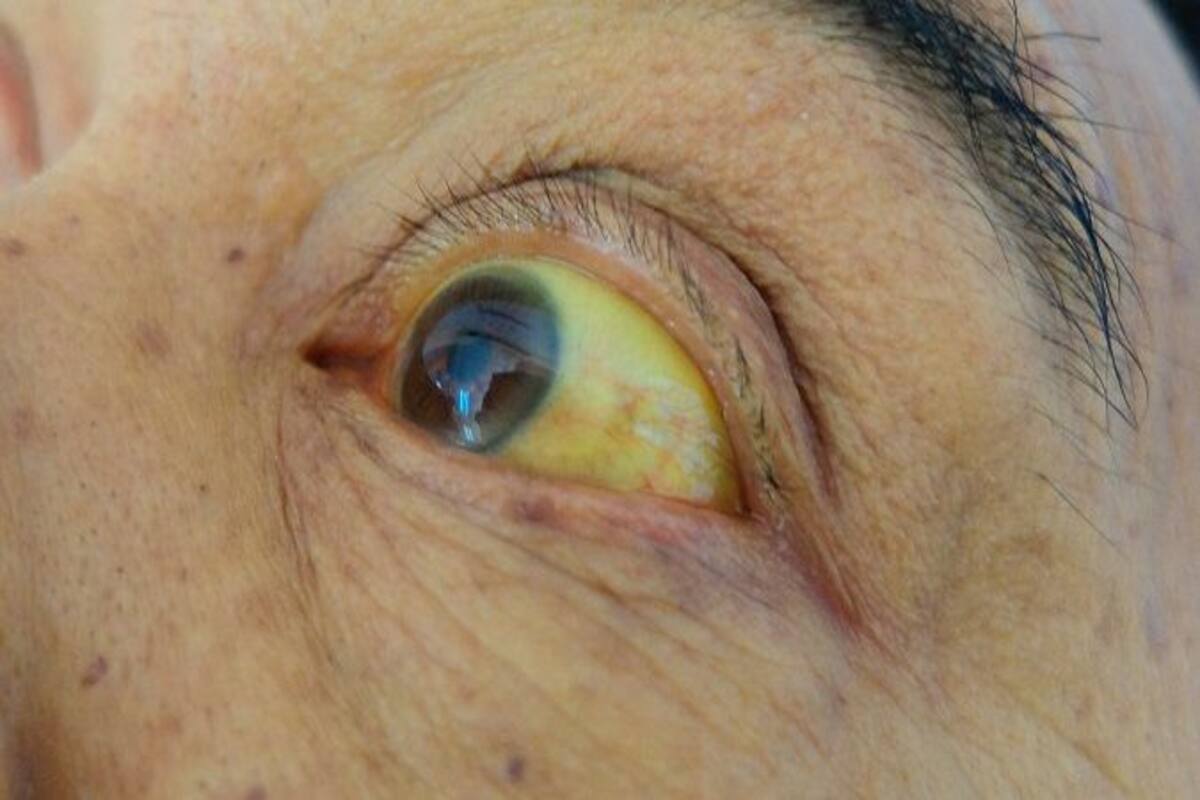 Not Just Liver Hepatitis B Virus May Take Away Your Vision Too Thehealthsite Com