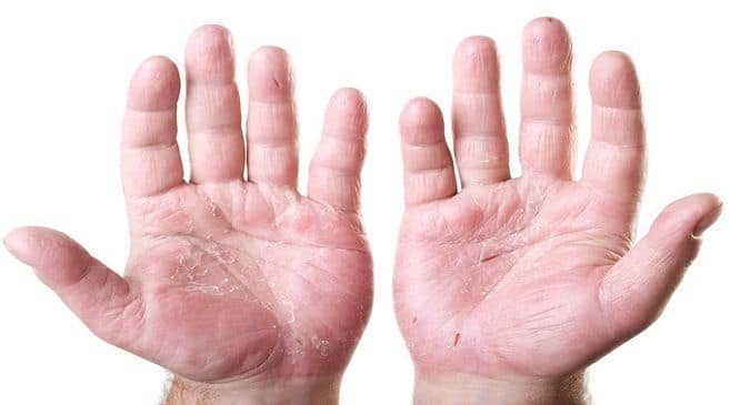 Top home remedies for your peeling palm | TheHealthSite.com