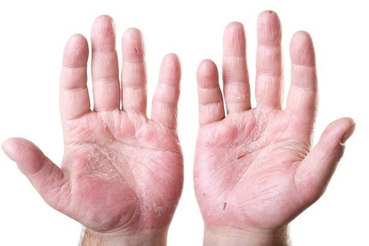Top 6 Home Remedies For Your Peeling Palm Thehealthsite Com