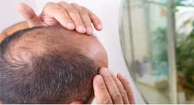 Baldness makes men more vulnerable to severe COVID-19 symptoms Baldness makes men more vulnerable to severe COVID-19 symptoms