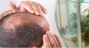 Tress talk: The ABC of hair transplantation