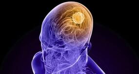 Scientists discover a molecule to fight certain brain tumour