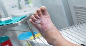 Arm your feet naturally to fight diabetic ulcers