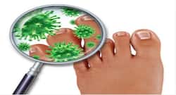 खतरनाक हो सकता है बरसात में फंगल इंफेक्शन, यूं रहें सुरक्षित