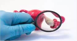 60 साल की महिला की ओवरी से डॉक्टरों ने निकाला 35 किलोग्राम का ट्यूमर