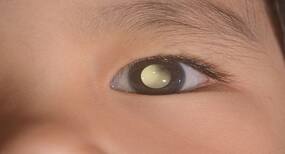 Late detection of Retinoblastoma due to lack of doctors is major scare