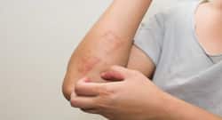 Want to get rid of skin infections? Follow these DIY tricks