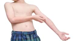All you need to know about meningococcal meningitis
