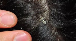 5 best home remedies to treat dandruff