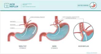 Factors That Can Increase Your Risk Of Acid Reflux Or Gerd |  Thehealthsite.com