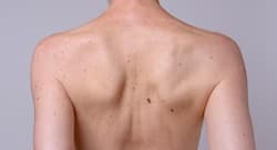 Top 5 home remedies to treat liver spots