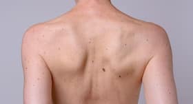 Top 5 home remedies to treat liver spots