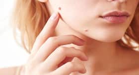 Know how tea tree oil can help you to get rid of moles Know how tea tree oil can help you to get rid of moles