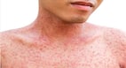 Want to treat chickenpox? Try these natural remedies