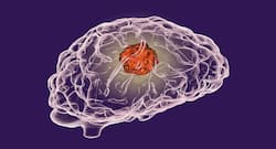 This AI based method curbs harmful impacts of chemotherapy doses on brain cancer patients