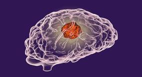 This AI based method curbs harmful impacts of chemotherapy doses on brain cancer patients